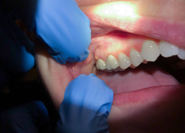 Best Emergency Dental Care for Broken or Chipped Teeth in Springfield, MN