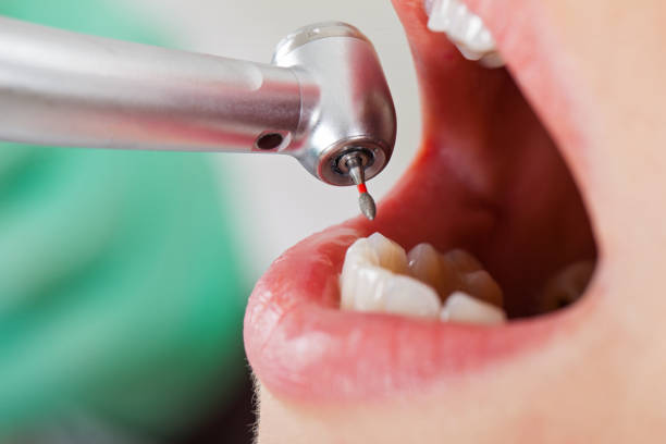 Best Emergency Root Canal Treatment in Springfield, MN